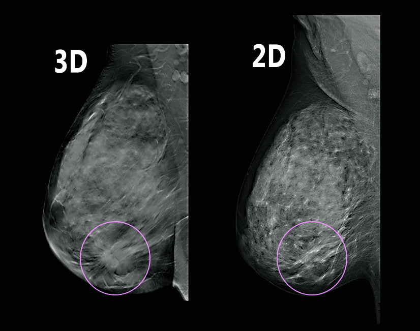 Diagnostic Digital Mammography